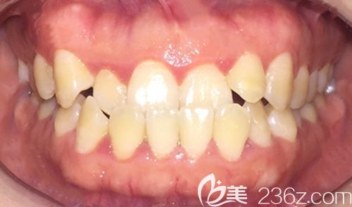 我在矯正前的地包天牙齒圖 我在矯正前的地包天牙齒圖