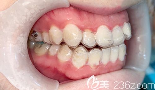 戴隱形牙套矯正兩個(gè)月時(shí)的效果 戴隱形牙套矯正兩個(gè)月時(shí)的效果