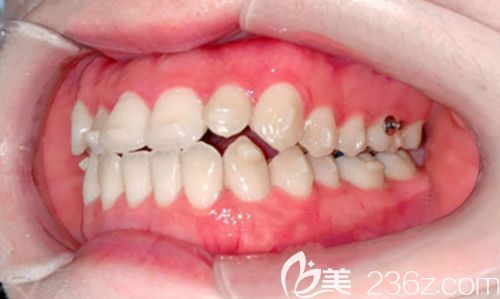 矯正牙性地包天6個(gè)月的效果圖 矯正牙性地包天6個(gè)月的效果圖