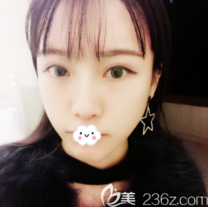 廣州韓妃李光琴醫(yī)生做雙眼皮失敗修復(fù)口碑技術(shù)也相當(dāng)靠譜哦