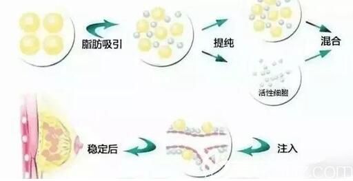 自體脂肪豐胸首先要對脂肪細(xì)胞進(jìn)行純化分離