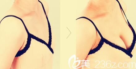 自體脂肪豐胸案例對比圖