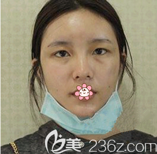 術(shù)前的我 術(shù)前的我