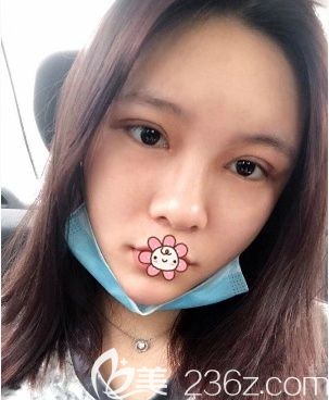 蘭宇醫(yī)生給我做完雙眼皮術(shù)后一周 蘭宇醫(yī)生給我做完雙眼皮術(shù)后一周