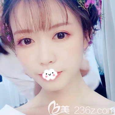 廣州廣大整形醫(yī)院王政醫(yī)生做的隆鼻<span style=