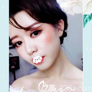 看了醫(yī)院資質(zhì)確定廣州廣大醫(yī)院是正規(guī)醫(yī)院后找王政做了鼻綜合隆鼻