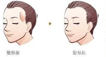 自體脂肪豐太陽穴 自體脂肪豐太陽穴