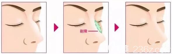 駝峰鼻矯正