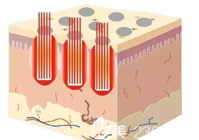 點(diǎn)陣激光的示意圖