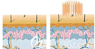 點(diǎn)陣激光祛痘的樣子