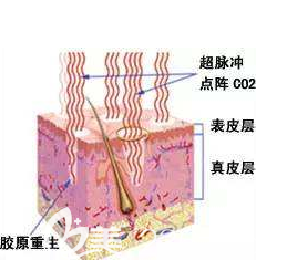 點(diǎn)陣激光對(duì)皮膚的刺激