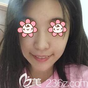 論下巴的重要性：分享我在沈陽名流美容醫(yī)院做硅膠假體墊下巴恢復過程效果圖！