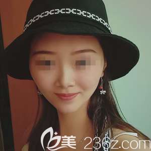 <!--<i data=20240703-sp></i>-->整形醫(yī)生陳珍為我做皮秒祛斑術(shù)后一周色斑祛除 <!--<i data=20240703-sp></i>-->整形醫(yī)生陳珍為我做皮秒祛斑術(shù)后一周色斑祛除