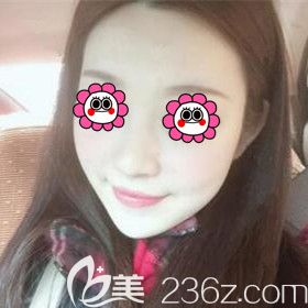 在雅美注射玻尿酸墊下巴術(shù)后11天效果照