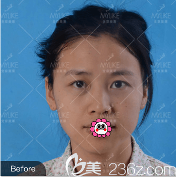 我在北京美萊做上瞼提肌和雙眼皮前樣子 我在北京美萊做上瞼提肌和雙眼皮前樣子