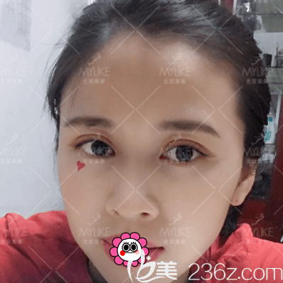我在北京美萊做上瞼提肌和雙眼皮第30天效果 我在北京美萊做上瞼提肌和雙眼皮第30天效果