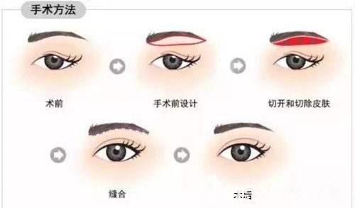 合并雙眼皮手術(shù)步驟示意圖