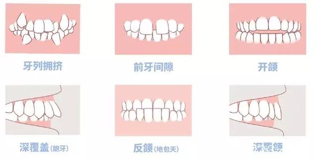 孔明星醫(yī)生科普:什么時候給孩子矯正牙齒好呢 孔明星醫(yī)生科普:什么時候給孩子矯正牙齒好呢