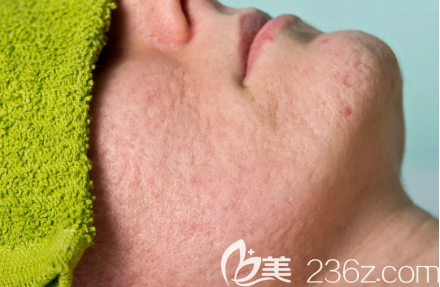 縮小毛孔改善粗糙 縮小毛孔改善粗糙