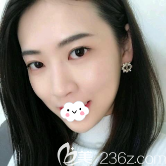 內(nèi)江達(dá)芬奇面部線雕提升術(shù)后側(cè)臉效果