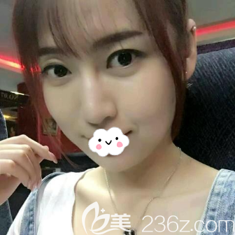 埋線提升術(shù)前側(cè)臉照片