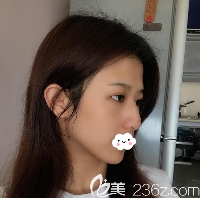 駝峰鼻矯正術前側(cè)面照片