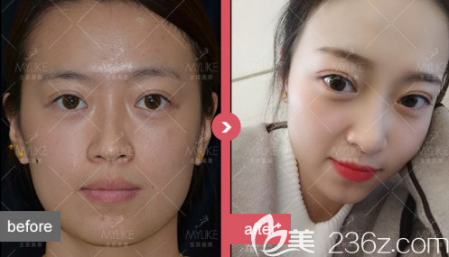 北京美萊紋眉案例 北京美萊紋眉案例