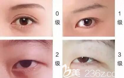 需要開眼角的情況之一有內眥贅皮者