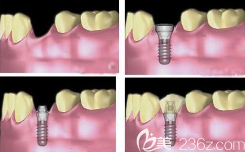 北京維嘉口腔劉慧霞醫(yī)生科普種植牙術(shù)后注意事項