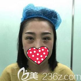 在名流做雙眼皮修復(fù)術(shù)后即刻效果照片