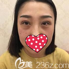 雙眼皮修復(fù)術(shù)后4天恢復(fù)效果照