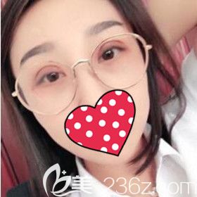 在沈陽名流修復(fù)雙眼皮術(shù)后20天效果照