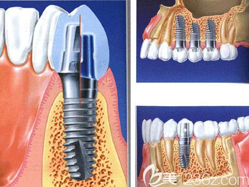 北京維嘉口腔任毅醫(yī)生介紹微創(chuàng)種植牙技術(shù)