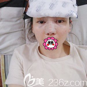 寧波靜港林忠泵做鼻綜合術(shù)后即刻