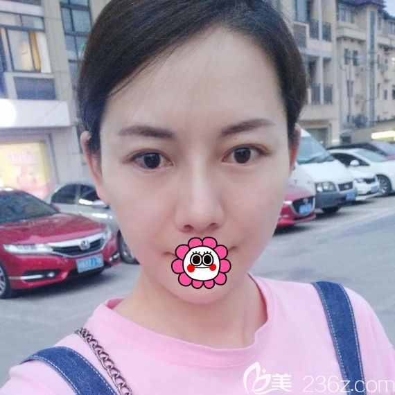 鼻綜合術(shù)后10天恢復(fù)效果