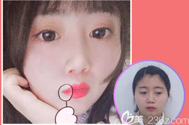 呼和浩特五洲王煥鼻綜合隆鼻案例效果圖