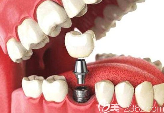 如何判斷種植牙是否成功？貝口腔種植醫(yī)生陳樺介紹