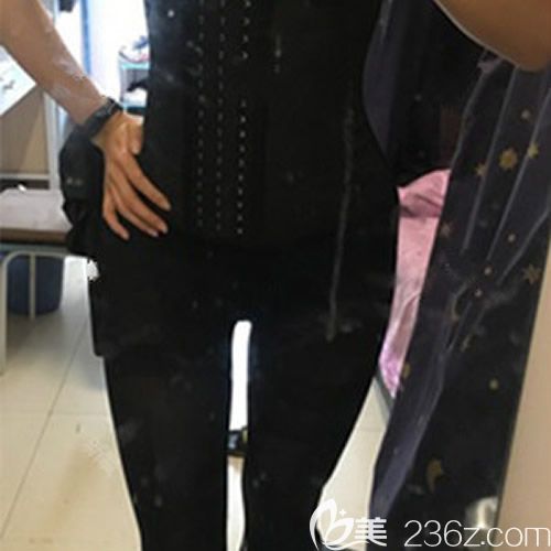 我找贛州薇琳鐘林輝做腰腹環(huán)吸術(shù)后第10天