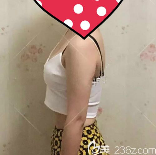 我找贛州薇琳鐘林輝做腰腹環(huán)吸術(shù)后第28天