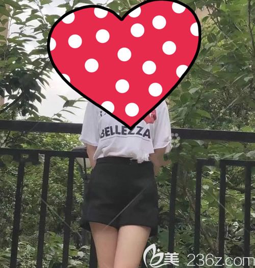 我找贛州薇琳鐘林輝做腰腹環(huán)吸術(shù)后60天效果