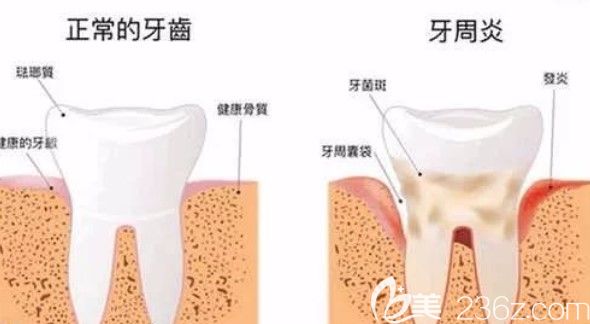 徐濤醫(yī)生來告訴大家:牙周炎是不是必須要拔牙 徐濤醫(yī)生來告訴大家:牙周炎是不是必須要拔牙