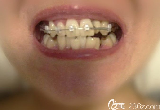 在優(yōu)貝口腔做牙齒矯正初戴上牙套