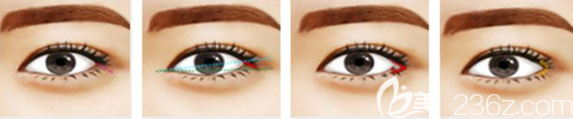 開外眼角手術(shù)過程圖