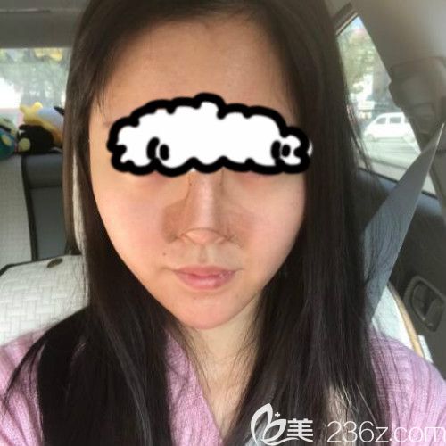 在贛州薇琳醫(yī)療美容成功做了隆鼻失敗修復(fù)手術(shù)后第4天