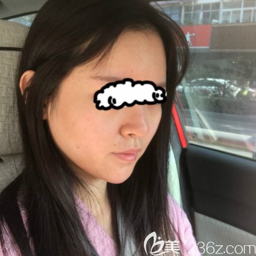 在贛州薇琳醫(yī)療美容成功做了隆鼻失敗修復(fù)手術(shù)第15天