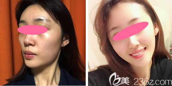 真實(shí)案例：我做完pst面部提升術(shù)四個(gè)月效果對(duì)比圖