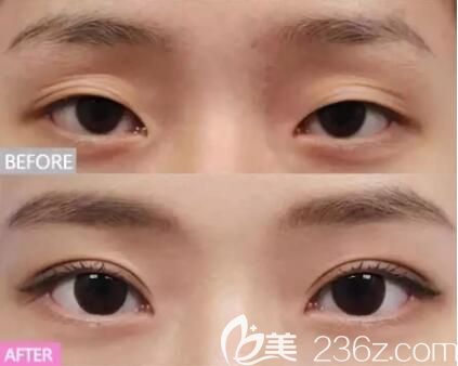 多眼皮矯正