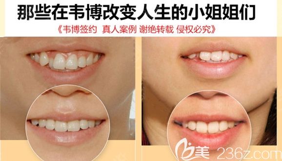 深圳韋博口腔牙齒矯正案例效果圖 深圳韋博口腔牙齒矯正案例效果圖