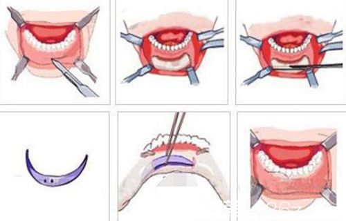 硅膠墊下巴手術(shù)步驟原理圖
