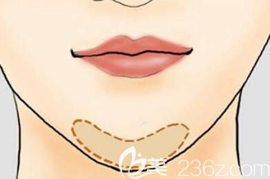 硅膠墊下巴原理